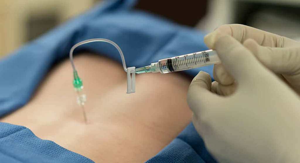 Epidural Steroid Enjeksiyonu